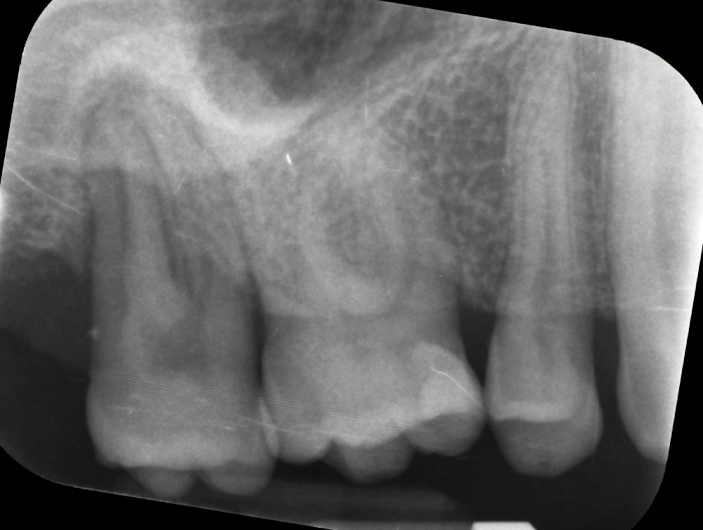 Antes de la endodoncia