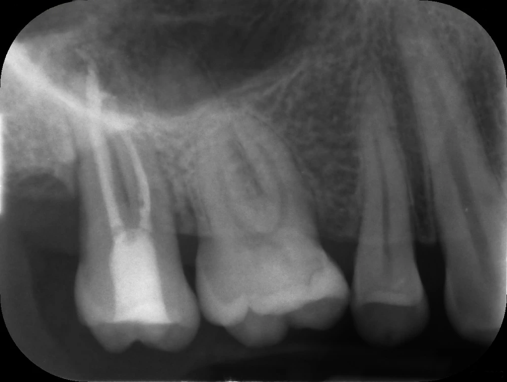 Después de la endodoncia