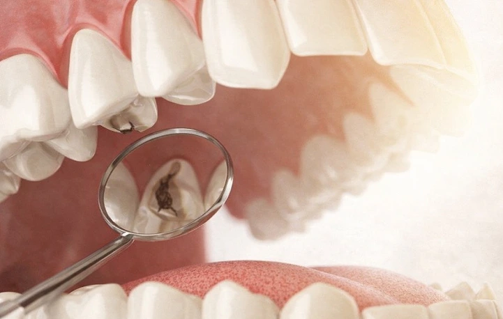dentadura con caries