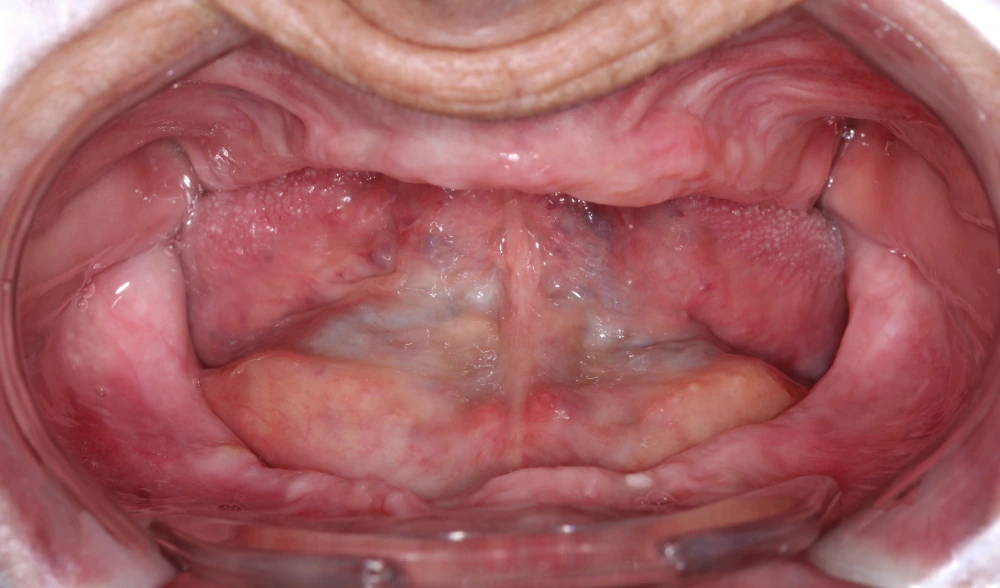 Prótesis dental antes del tratamiento