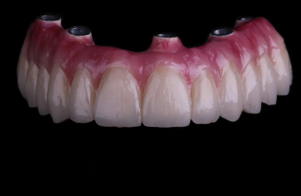 Prótesis sobre implantes fija