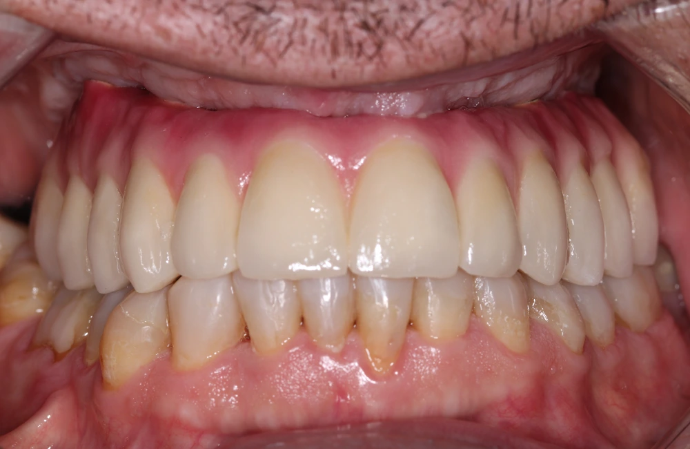 Prótesis sobre implantes fija implantada