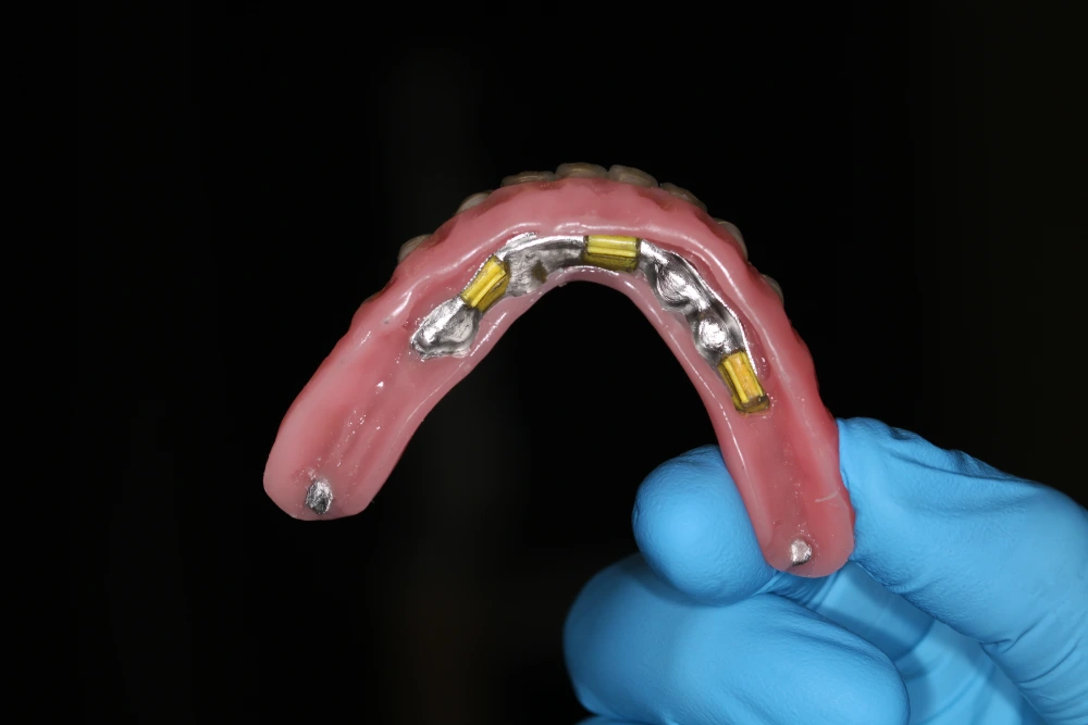 Implantología sobredentadura sobre barra pieza dental