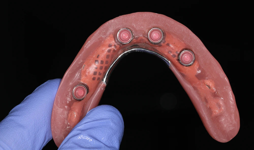Sobredentadura sobre locator pieza dental